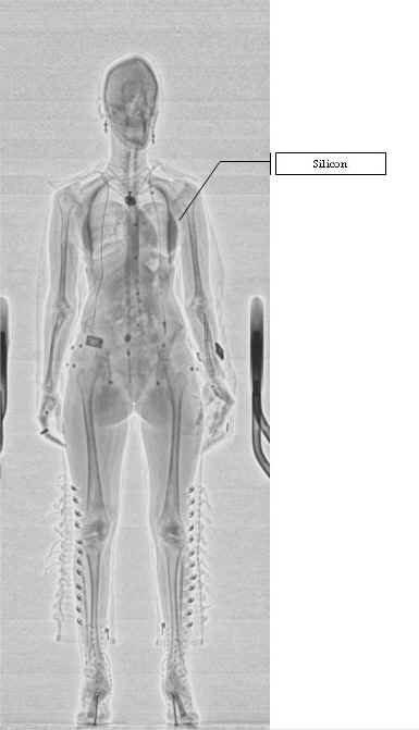 Рентгеновский досмотр. Цифровой рентгенографический сканер для персонального досмотра. Рентгеновские сканеры для персонального досмотра людей. Рентгеновский сканер на основе обратного рассеивания. Рентгеновский сканер «Homoscan».